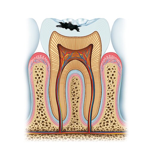 Dentist Encino Tooth Decay