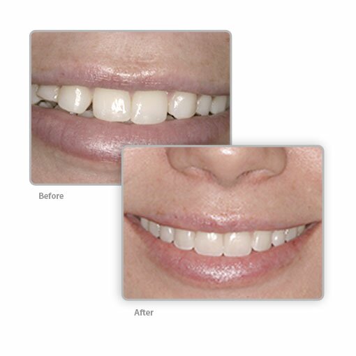 Dentist Encino Veneers